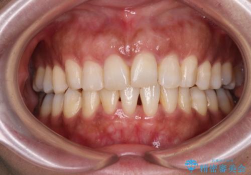 インビザラインでのんびりと矯正治療 の症例 治療後