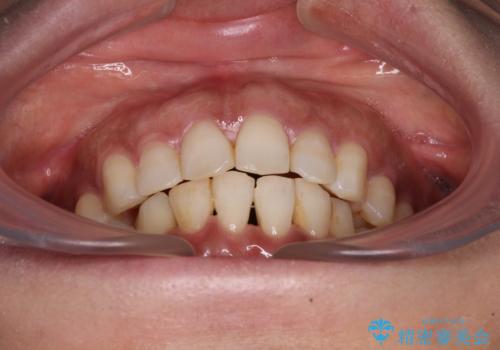 インビザラインでのんびりと矯正治療 の治療後
