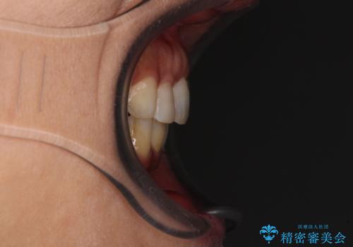 インビザラインでのんびりと矯正治療 の治療後