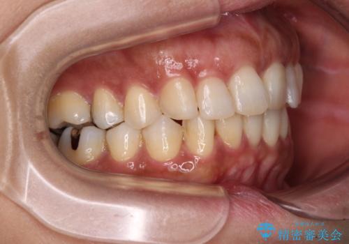 インビザラインでのんびりと矯正治療 の治療後