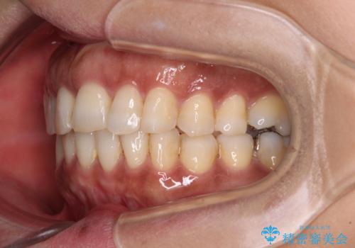 インビザラインでのんびりと矯正治療 の治療後