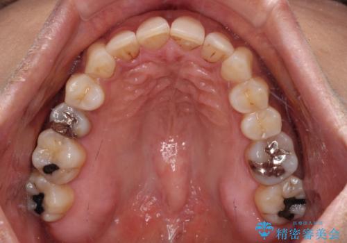 インビザラインでのんびりと矯正治療 の治療後