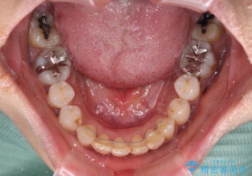 インビザラインでのんびりと矯正治療 の治療後