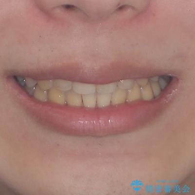 前歯のデコボコを治したい インビザライン矯正治療の治療後(顔貌)