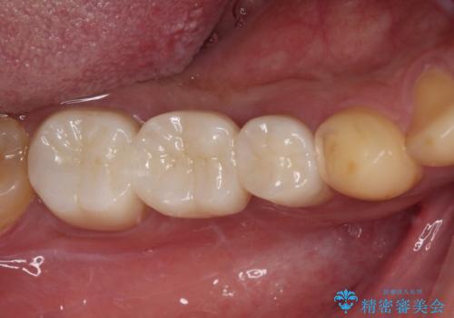 放置した虫歯　奥歯のオールセラミックブリッジ治療の症例 治療後