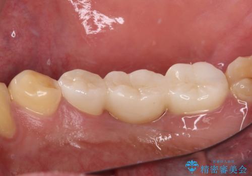 放置した虫歯 奥歯のオールセラミックブリッジ治療の治療後
