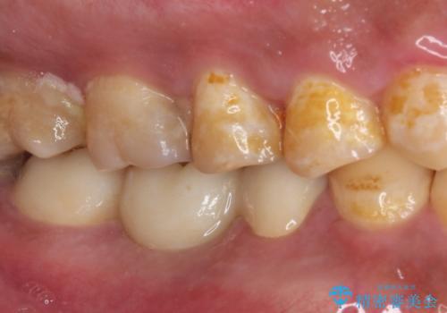 放置した虫歯 奥歯のオールセラミックブリッジ治療の治療後