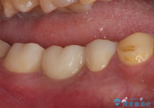 放置した虫歯 奥歯のオールセラミックブリッジ治療の治療後