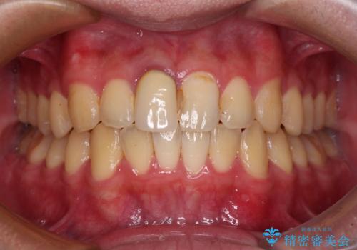 前歯のデコボコを治したい インビザライン矯正治療の症例 治療後