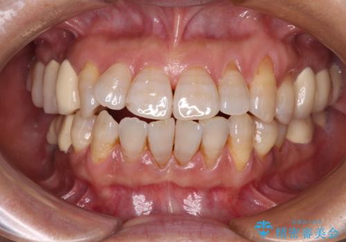 治療後に歯茎から出血 インプラントとオールセラミッククラウンの補綴治療の治療前