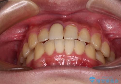 前歯のデコボコを治したい インビザライン矯正治療の治療後