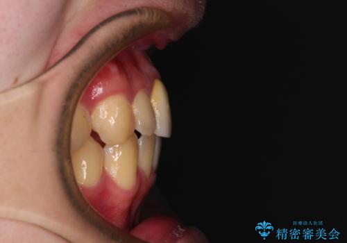 前歯のデコボコを治したい インビザライン矯正治療の治療後