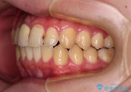 前歯のデコボコを治したい インビザライン矯正治療の治療後