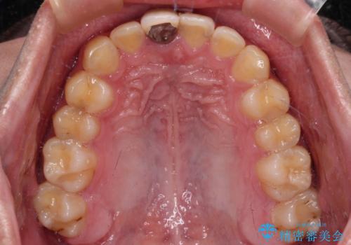 前歯のデコボコを治したい インビザライン矯正治療の治療後