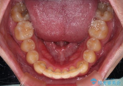 前歯のデコボコを治したい インビザライン矯正治療の治療後