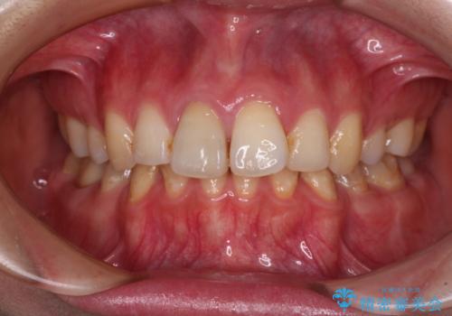 部分矯正を併用した奥歯のインプラント治療の治療後