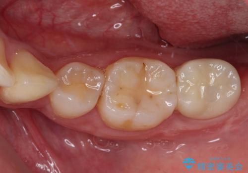 部分矯正を併用した奥歯のインプラント治療の治療後