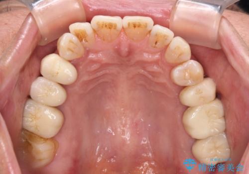 治療後に歯茎から出血 インプラントとオールセラミッククラウンの補綴治療の治療前
