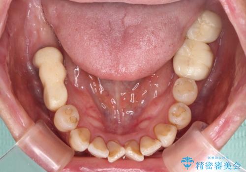 治療後に歯茎から出血 インプラントとオールセラミッククラウンの補綴治療の治療前
