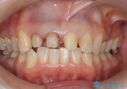 前歯のすき間　以前よりも広がってきた　二度と広がらないようにしたい　セラミック治療の治療中