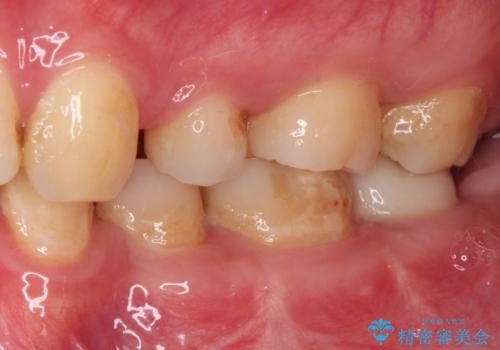 部分矯正を併用した奥歯のインプラント治療の治療後