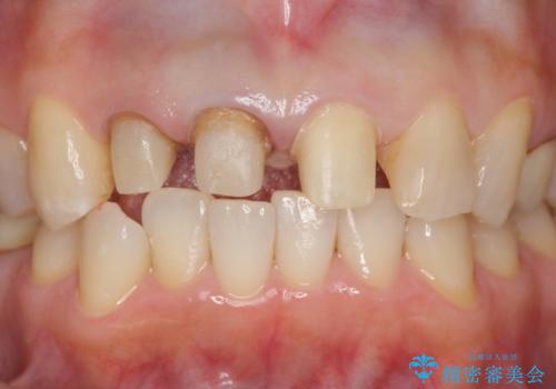 前歯のすき間 以前よりも広がってきた 二度と広がらないようにしたい セラミック治療の治療中