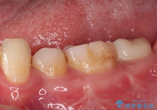 部分矯正を併用した奥歯のインプラント治療の治療後