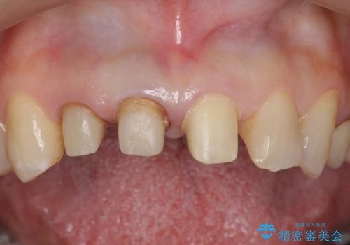 前歯のすき間　以前よりも広がってきた　二度と広がらないようにしたい　セラミック治療の治療中