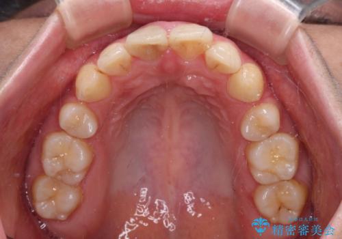 部分矯正を併用した奥歯のインプラント治療の治療後