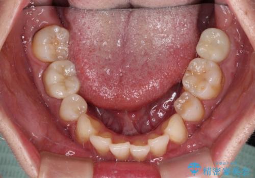 部分矯正を併用した奥歯のインプラント治療の治療後