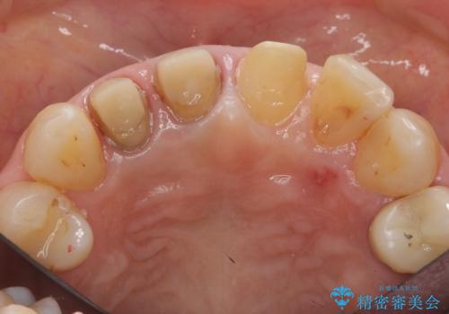 前歯のすき間 以前よりも広がってきた 二度と広がらないようにしたい セラミック治療の治療中