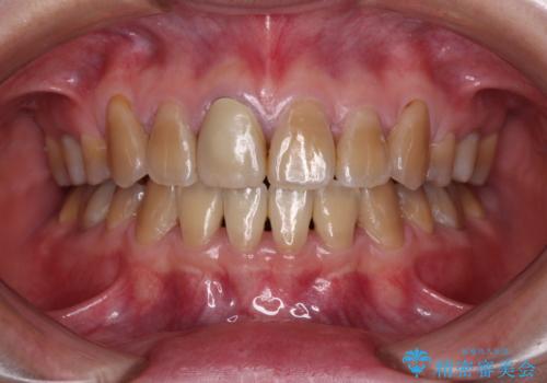 八重歯とクロスバイト　目立たないワイヤー装置での抜歯矯正の症例 治療後