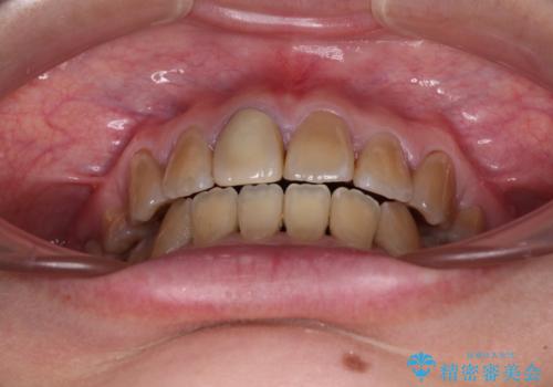 八重歯とクロスバイト 目立たないワイヤー装置での抜歯矯正の治療後