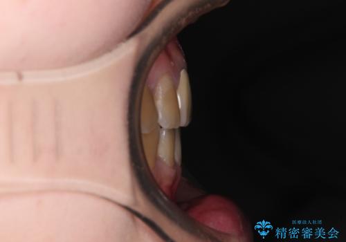 八重歯とクロスバイト　目立たないワイヤー装置での抜歯矯正の治療後
