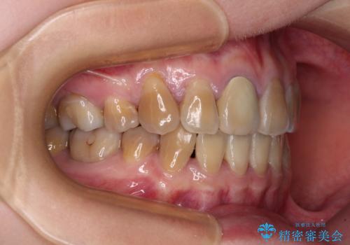 八重歯とクロスバイト　目立たないワイヤー装置での抜歯矯正の治療後