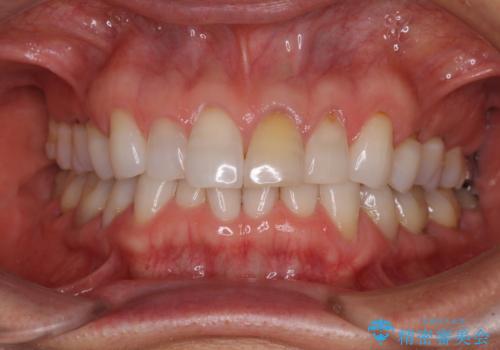 矯正治療の後戻り インビザライン・ライトでの再矯正の症例 治療前