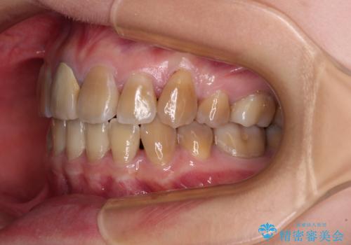 八重歯とクロスバイト 目立たないワイヤー装置での抜歯矯正の治療後