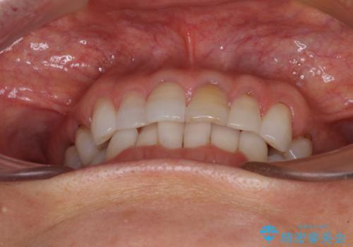 矯正治療の後戻り インビザライン・ライトでの再矯正の治療前