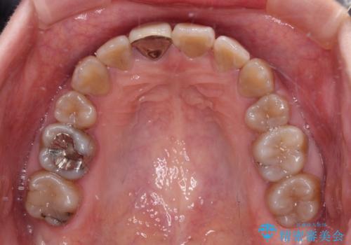 八重歯とクロスバイト 目立たないワイヤー装置での抜歯矯正の治療後