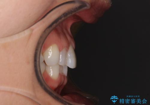 矯正治療の後戻り インビザライン・ライトでの再矯正の治療前