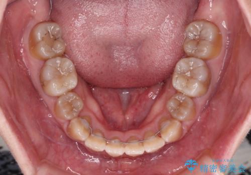 八重歯とクロスバイト 目立たないワイヤー装置での抜歯矯正の治療後