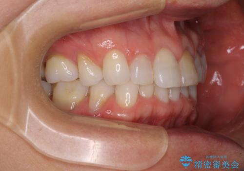 矯正治療の後戻り インビザライン・ライトでの再矯正の治療前
