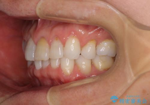 矯正治療の後戻り インビザライン・ライトでの再矯正の治療前