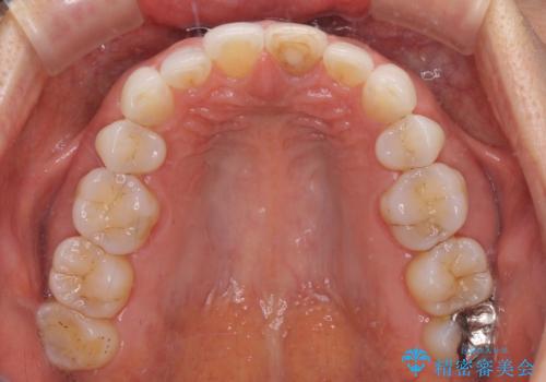 矯正治療の後戻り インビザライン・ライトでの再矯正の治療前