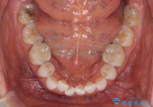 矯正治療の後戻り インビザライン・ライトでの再矯正の治療前