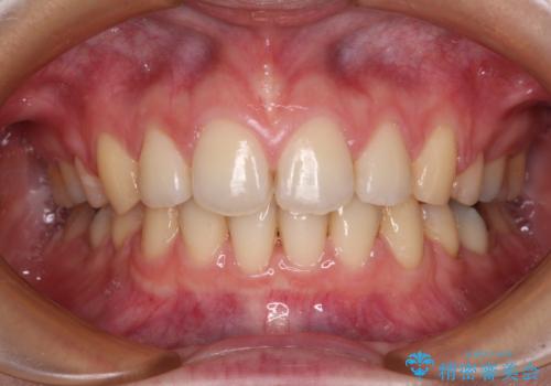 【モニター】口が閉じにくい 目立たないワイヤー装置で口元を引っ込める