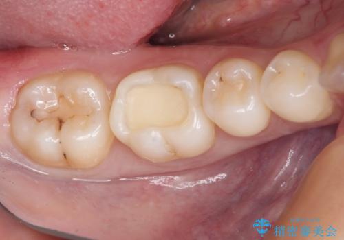 むし歯治療した歯にセラミックを入れたい セラミックインレー修復の治療中