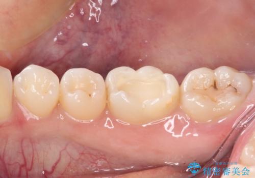 むし歯治療した歯にセラミックを入れたい セラミックインレー修復の治療中