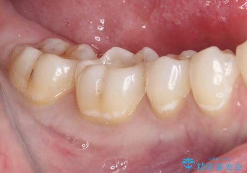 むし歯治療した歯にセラミックを入れたい セラミックインレー修復の治療中