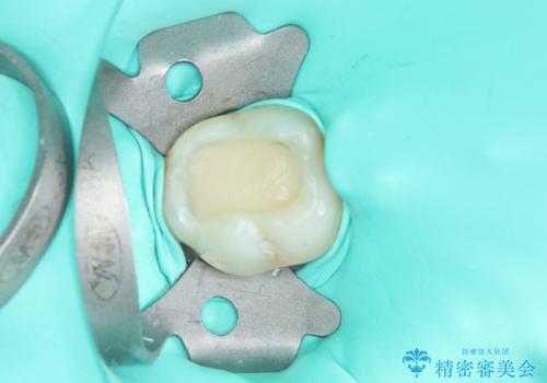 むし歯治療した歯にセラミックを入れたい セラミックインレー修復の治療中